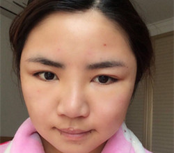 下颌角+颧骨手术前后过程以及真实果对比图