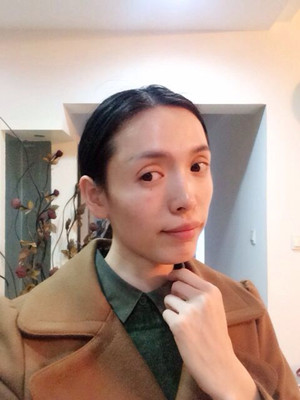 玻尿酸面部填充前后过程及对比图片，来看看果如何