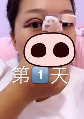 终于把双眼皮割了，无锡菲尚张树功做的