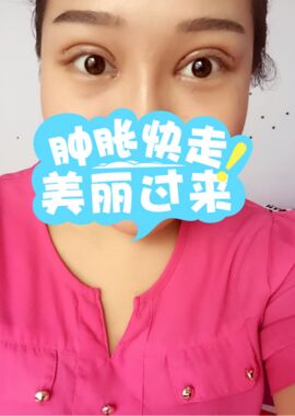 终于把双眼皮割了，无锡菲尚张树功做的