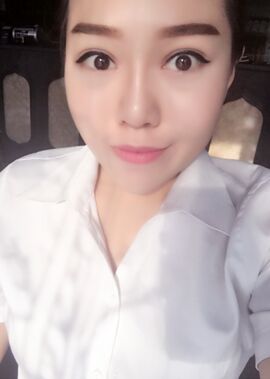 终于把双眼皮割了，无锡菲尚张树功做的