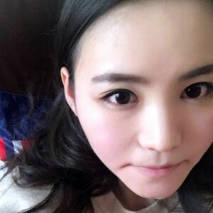 埋埋蛋白线.提升后脸上变得紧致许多，轮廓变得更好看