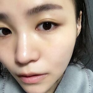 埋埋蛋白线.提升后脸上变得紧致许多，轮廓变得更好看