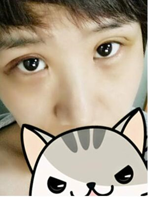 全切双眼皮让我跻身大眼一族