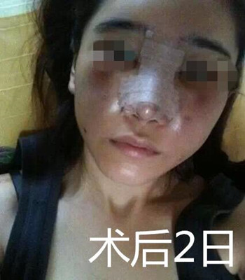 做了自体脂肪面部填充和隆鼻 整个面部都立体起来了
