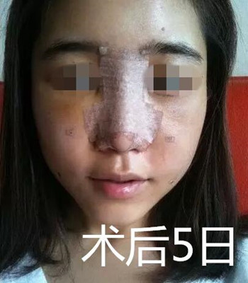 做了自体脂肪面部填充和隆鼻 整个面部都立体起来了