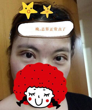 小眼睛变大眼睛 只需要一个全切双眼皮