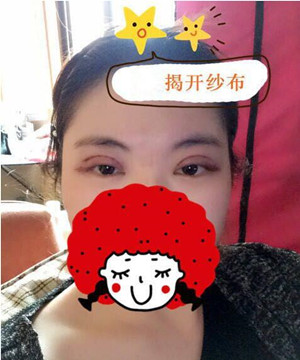 小眼睛变大眼睛 只需要一个全切双眼皮