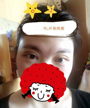小眼睛变大眼睛 只需要一个全切双眼皮