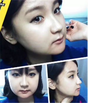 做了磨下颌角整形手术4个月了，晒晒我的恢复前后的对比照片吧~~