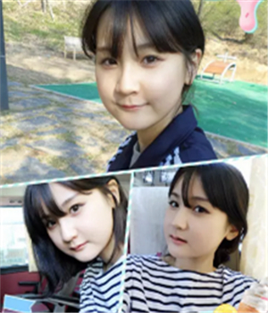 做了磨下颌角整形手术4个月了，晒晒我的恢复前后的对比照片吧~~