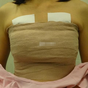 做了自体脂肪移植丰胸手术，勾勒出**胸部曲线，看看果照片~~