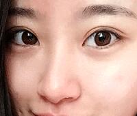 内切去眼袋价格2180元，祛眼袋前后对比图分享给大家