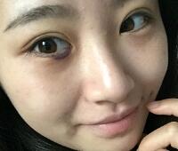 内切去眼袋价格2180元，祛眼袋前后对比图分享给大家