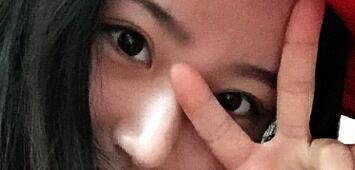 祛眼袋术后恢复