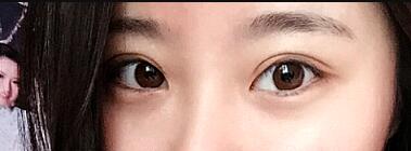 祛眼袋手术价格分享