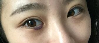 内切祛眼袋手术恢复图