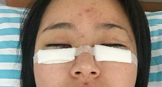 祛眼袋手术图，恢复过程