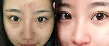 祛眼袋前后对比图