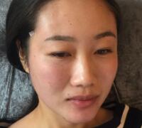 自体脂肪面部填充价格12800元案例