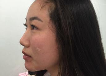 大腿的脂肪做填充自体脂肪后的图片