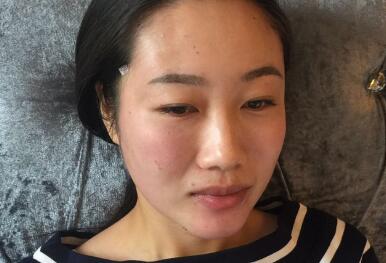 自体脂肪面部填充第二天消了一些肿