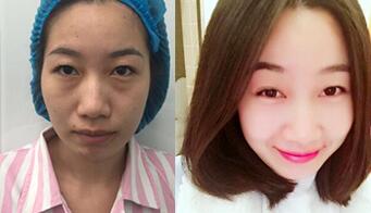 自体脂肪面部填充前后对比图