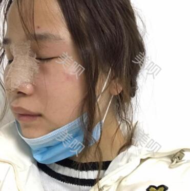 在苏州常春藤做的硅胶假体隆鼻为大家分享下我的恢复全过程吧