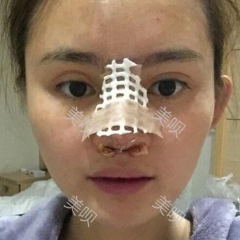 玻尿酸隆鼻花了两万多果很自然哦，值~！