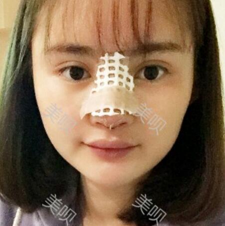 玻尿酸隆鼻花了两万多果很自然哦，值~！