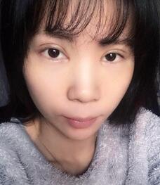 长沙美之峰重睑+开眼角恢复过程图