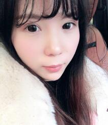 长沙美之峰重睑+开眼角恢复过程图