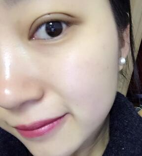 长沙美之峰割双眼皮3个月了