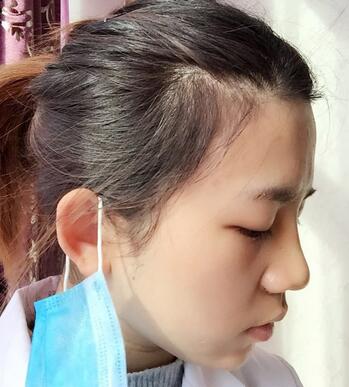 长沙美之峰假体隆鼻恢复日记