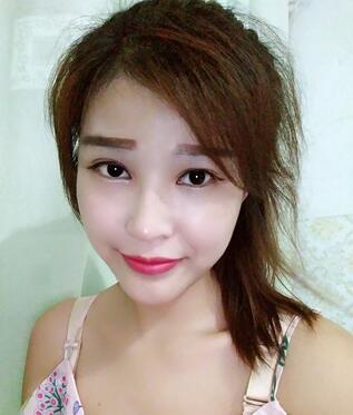 长沙美之峰隆鼻整形手术恢复日记图