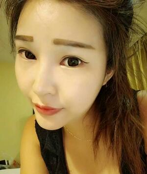 长沙美之峰隆鼻整形手术恢复日记图