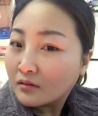 金子甘国端医生给我做完高强度聚焦超声之后皮肤紧致多了