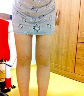 吸脂瘦大腿让我夏天放肆(｡･∀･)ﾉﾞ