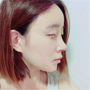 蒋医生做的隆鼻失败修复分享，还有前后对比果图片哦~