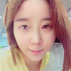 蒋医生做的隆鼻失败修复分享，还有前后对比果图片哦~