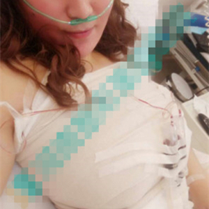 分享我自体脂肪隆胸手术前后对比照片，果不错哦~