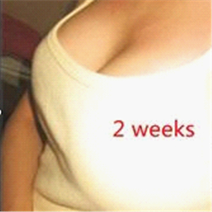 分享我自体脂肪隆胸手术前后对比照片，果不错哦~