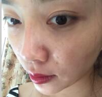 自体脂肪隆鼻、垫下巴、丰苹果肌前后对比图和恢复过程分享