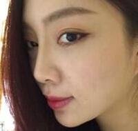 自体脂肪隆鼻、垫下巴、丰苹果肌前后对比图和恢复过程分享