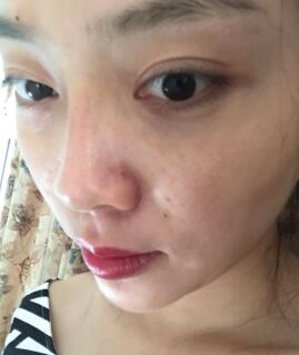 自体脂肪隆鼻、垫下巴、丰苹果肌