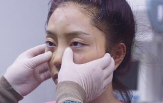 自体脂肪面部填充术前检查