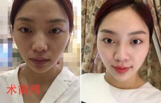 自体脂肪面部填充前术后对比照