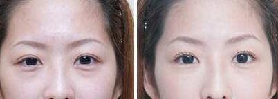 超声波去眼袋前后对比图，价格