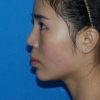 隆鼻失败修复后果自然宛若天生