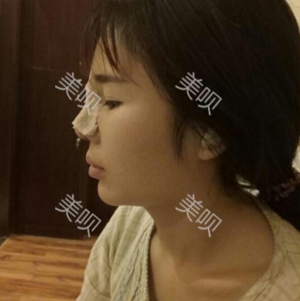 隆鼻失败修复后果自然宛若天生